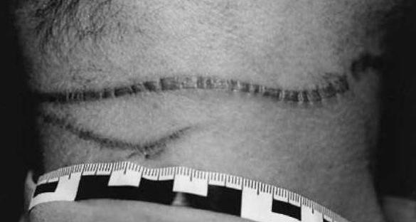 signs of strangulation furrow