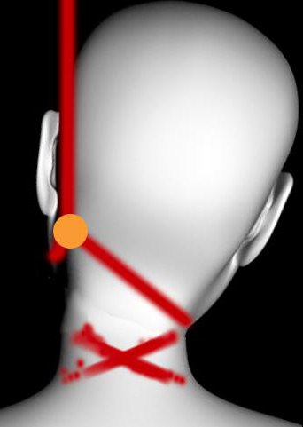 strangulation furrow when removing the loop