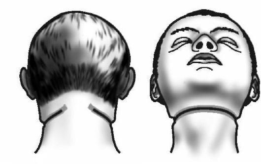 closed strangulation furrow