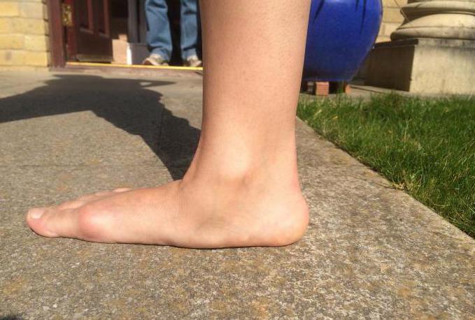 flat feet 3 degrees photo