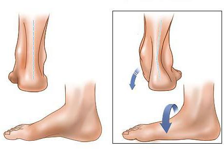 Is it possible to cure flat feet of 3 degrees