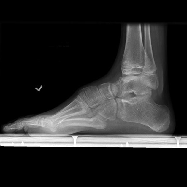 platypodia 2 degrees take in the army