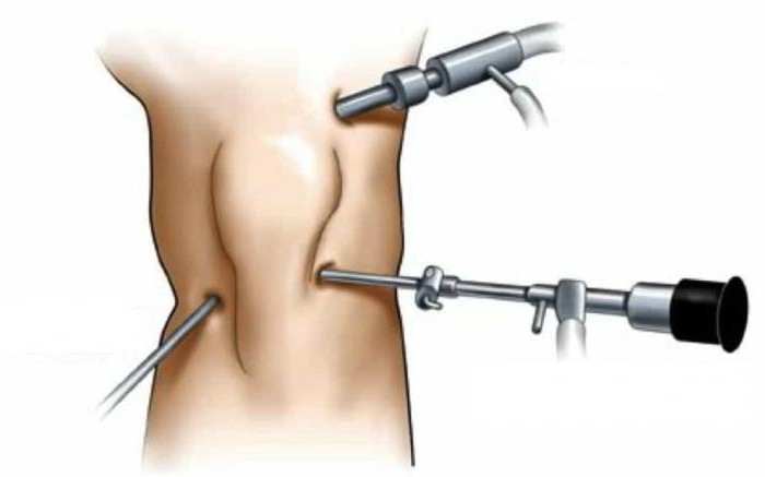  meniscus replacement of the knee