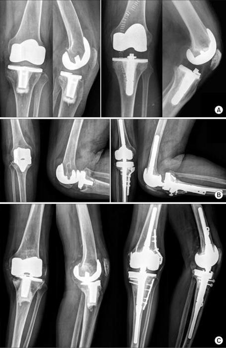  knee replacement reviews