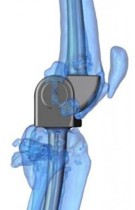  rehabilitation after knee replacement