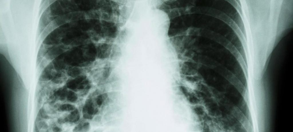 How harmful is fluorography?
